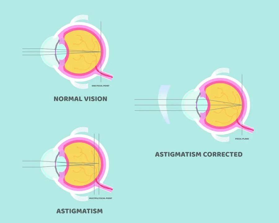 Astigmatism Treatment in Chicago, IL Kraff Eye Institute